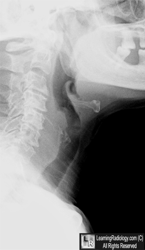 learningradiology-foreign-body-perforation-chicken-bone